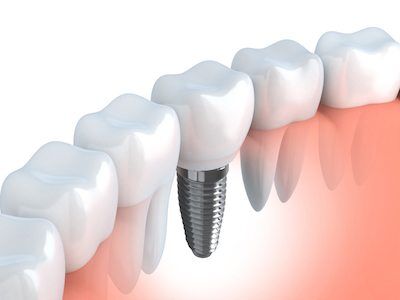 dental implant diagram