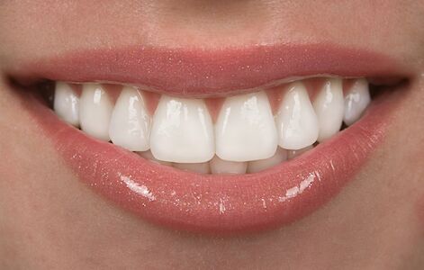 closeup of patient with dental veneers