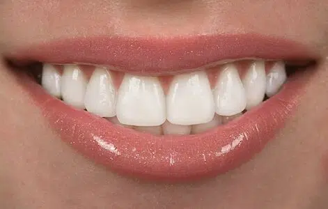 closeup of patient with dental veneers