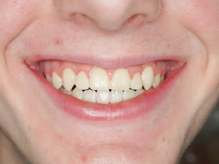 After image